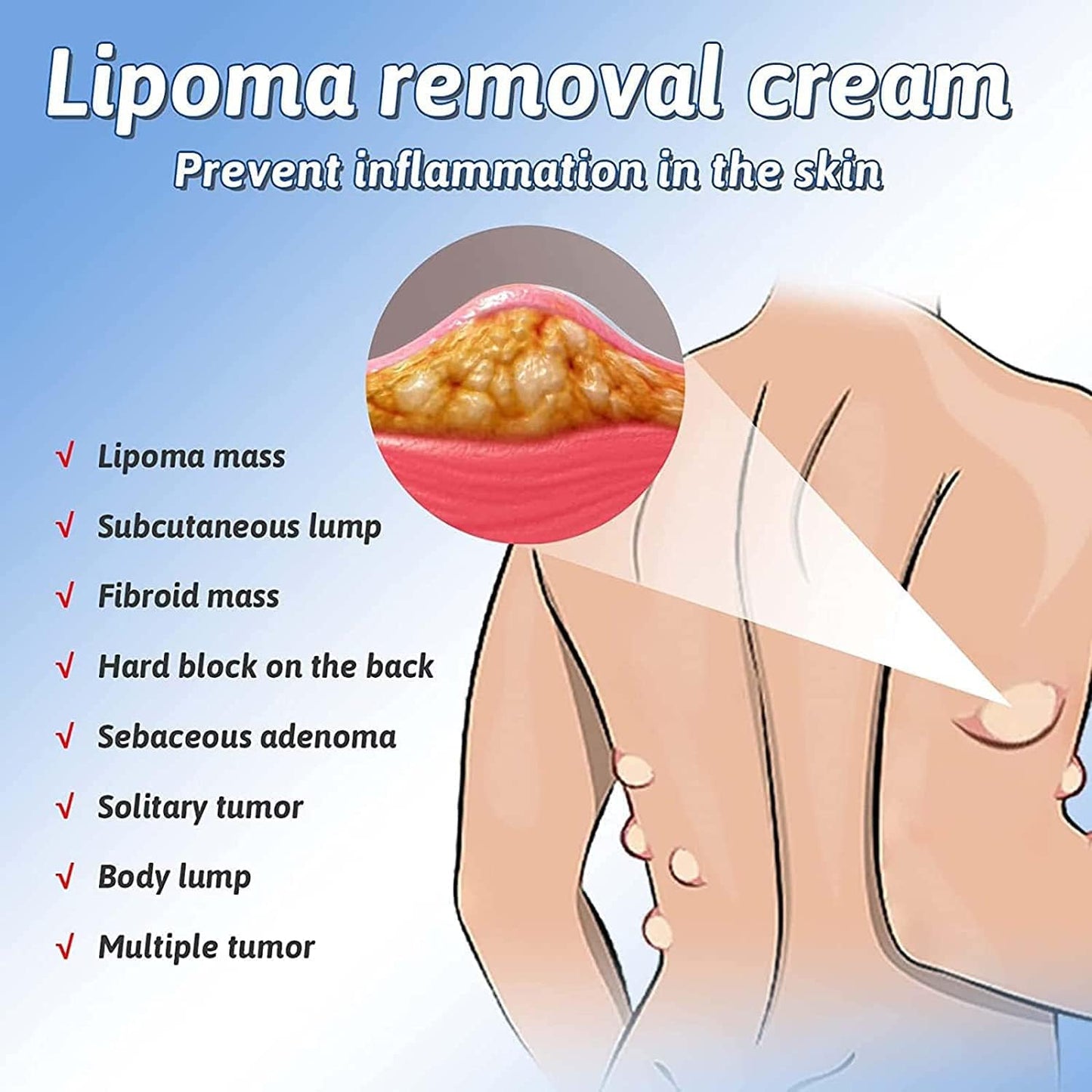 Lipoma Removal Cream