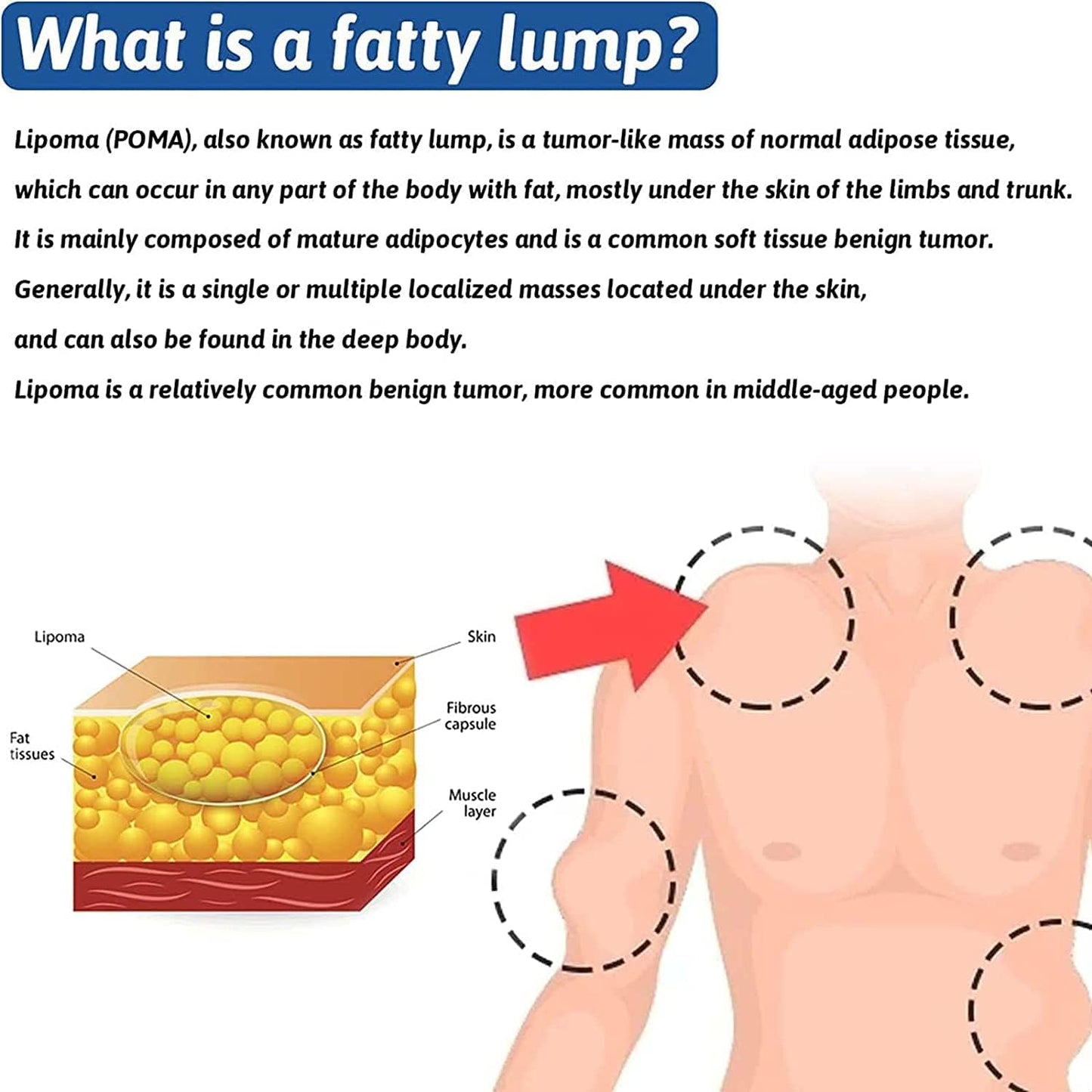 Lipoma Removal Cream